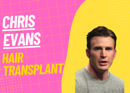 Chris Evans Hair Transplant: Fact or Fiction?