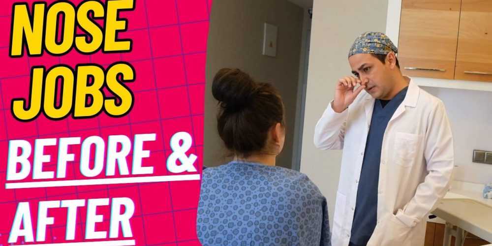 Nose Jobs Before After