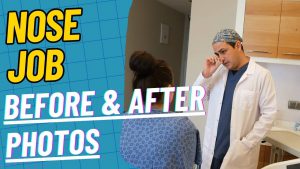 Nose Job Before After featured