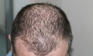 My Hair is So Thin