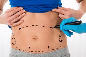 tummy tuck