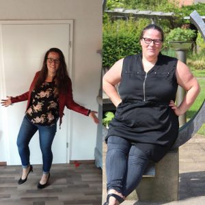 gastric sleeve before and after skin