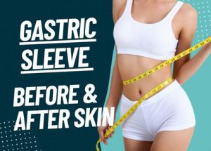 Gastric Sleeve Before and After Skin