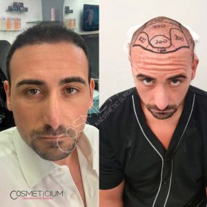 Cosmeticium Hair Transplant Result before after photos-01