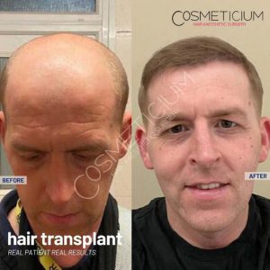 Cosmeticium Hair Transplant Result before after photos-06
