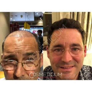 Cosmeticium Hair Transplant Result before after photos-04