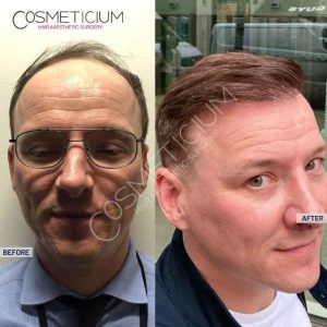 Cosmeticium Hair Transplant Result before after photos-03