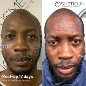 Cosmeticium Hair Transplant Result before after photos-02