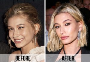 Hailey-Bieber--before-and-after