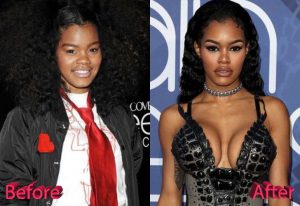 Teyana Taylor Nose Job Before After