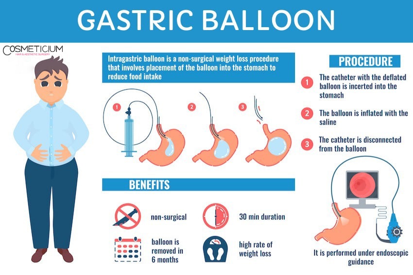 gastric balloon information infographic