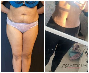 gastric sleeve before after skin patient photo