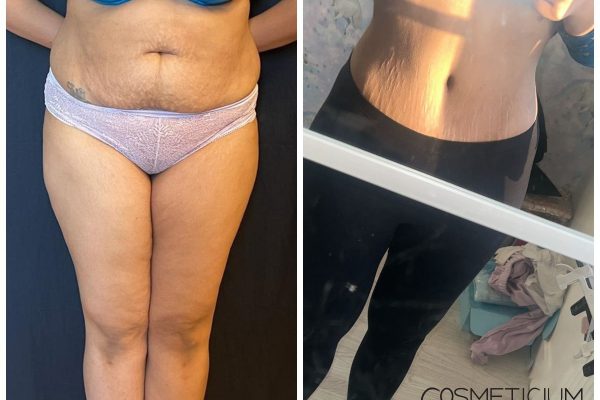 gastric sleeve before after skin patient photo