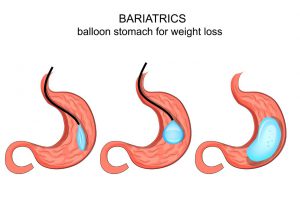 gastric-balloon