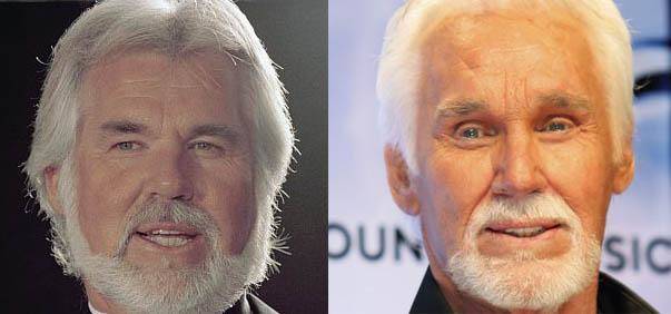 kenny-rogers plastic surgery