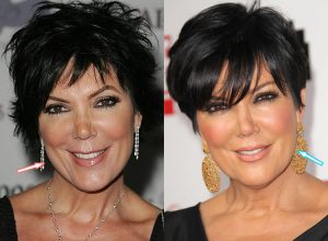kris jenner facelift Before After