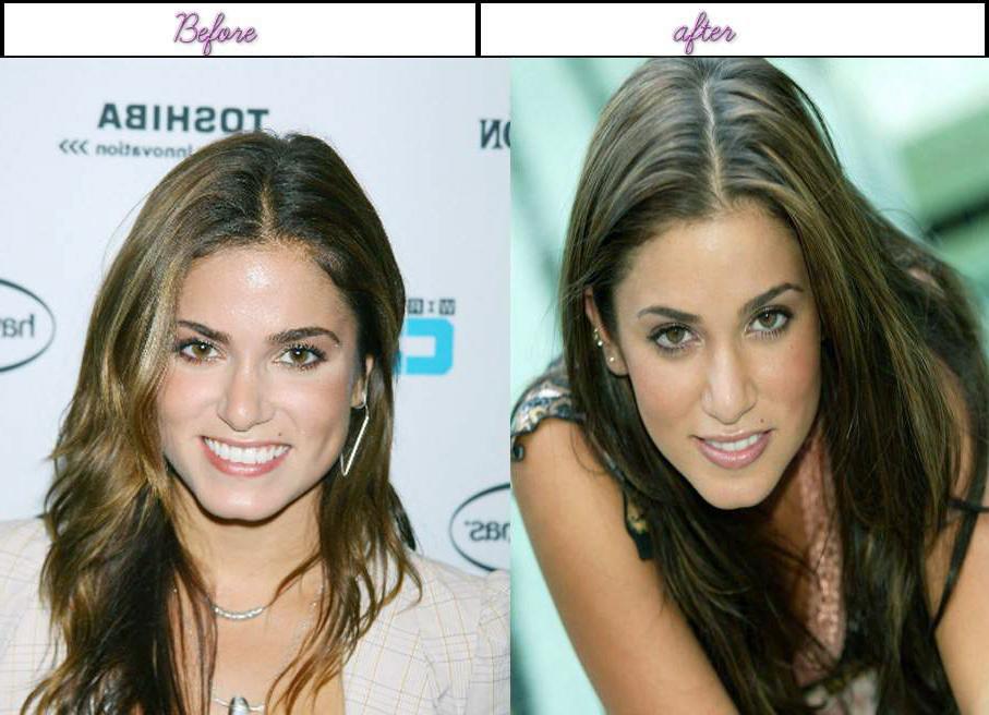 Nikki Reed nose job before after 