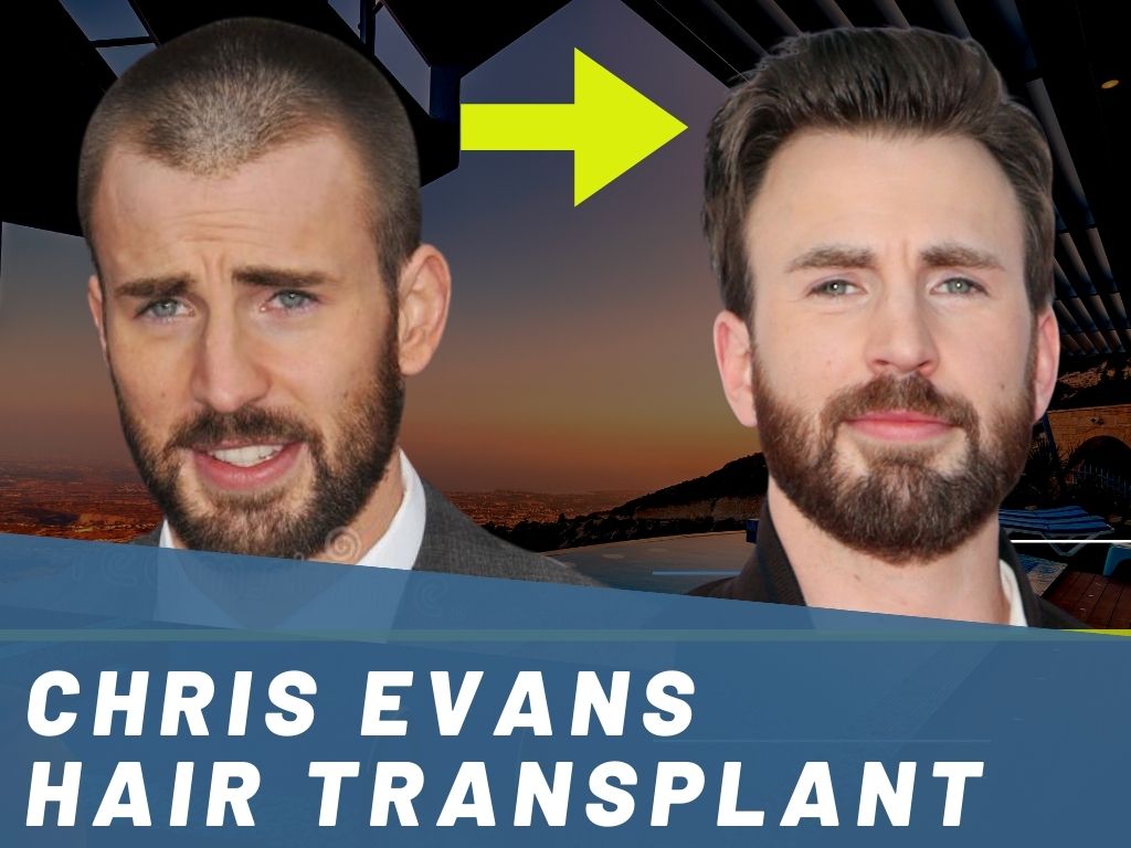 chris evans hair loss