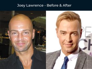 joey lawrence hair transplant