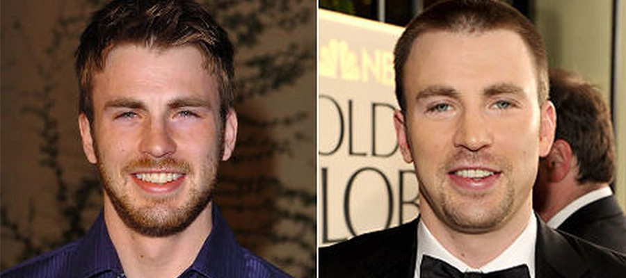 chris evans hair loss