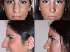 Jen Selter Nose Job