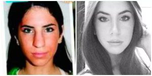 Jen Selter rhiboplasty