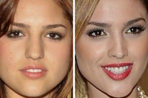Eiza Gonzalez nose job before after