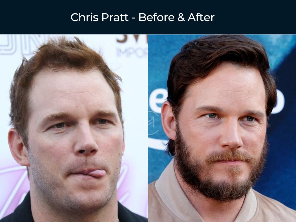 chris pratt hair transplant