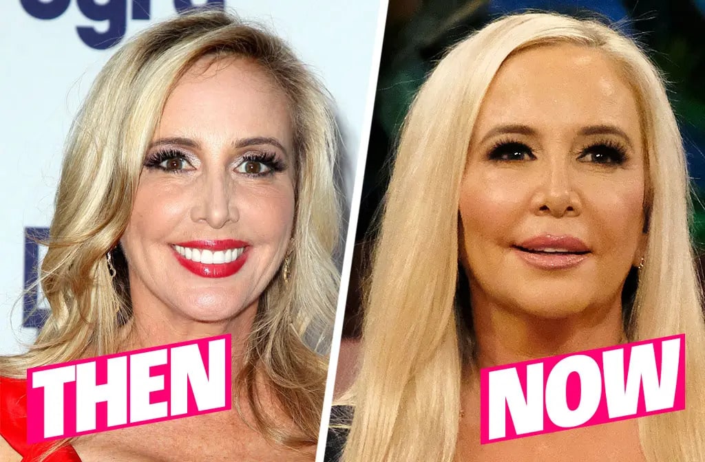 Shannon Beador before after nose