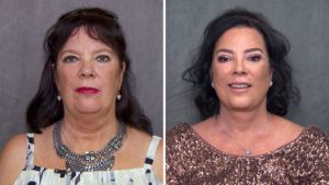kris jenner sister facelift