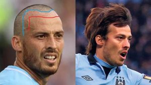 David Silva hair transplant front crown
