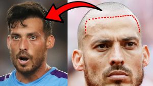 David Silva Hair Transplant