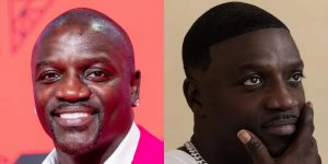 akon hair transplant