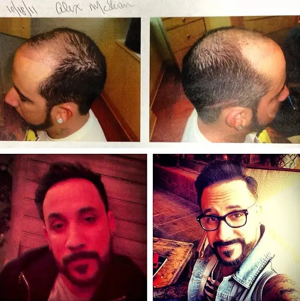 AJ McLean's Hair Transplant