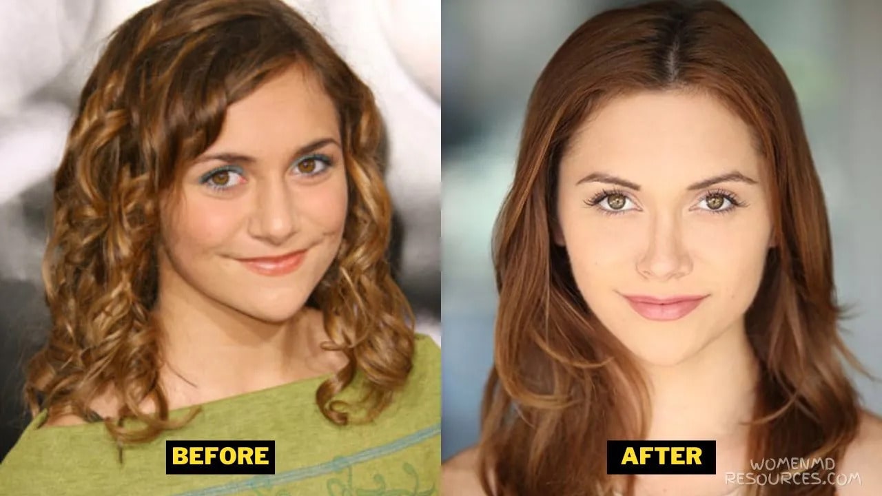 alyson stoner nose surgery