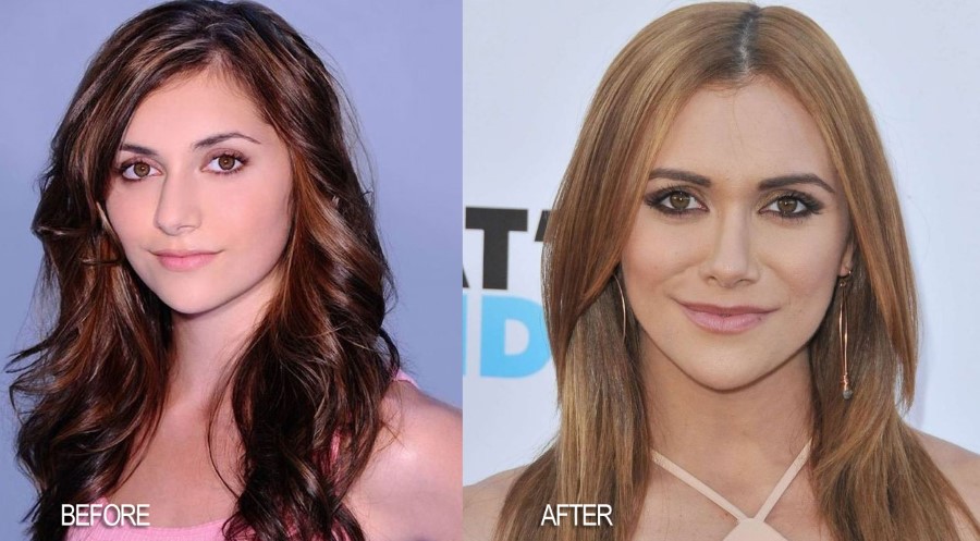 Alyson-Stoner-nose-job-before-and-after-