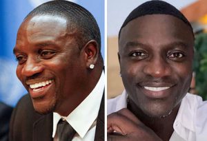 akon-hair-transplant