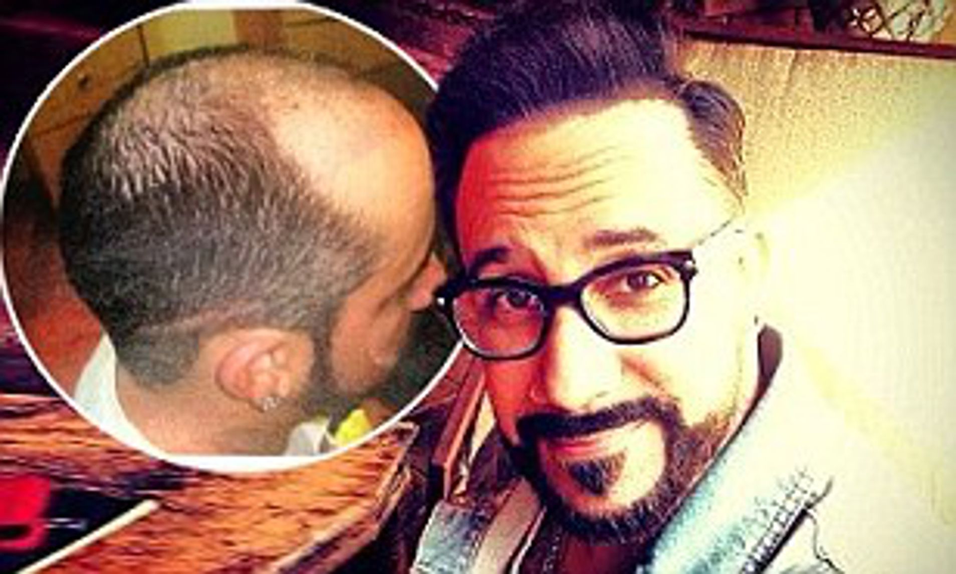 AJ McLean's Hair Transplant