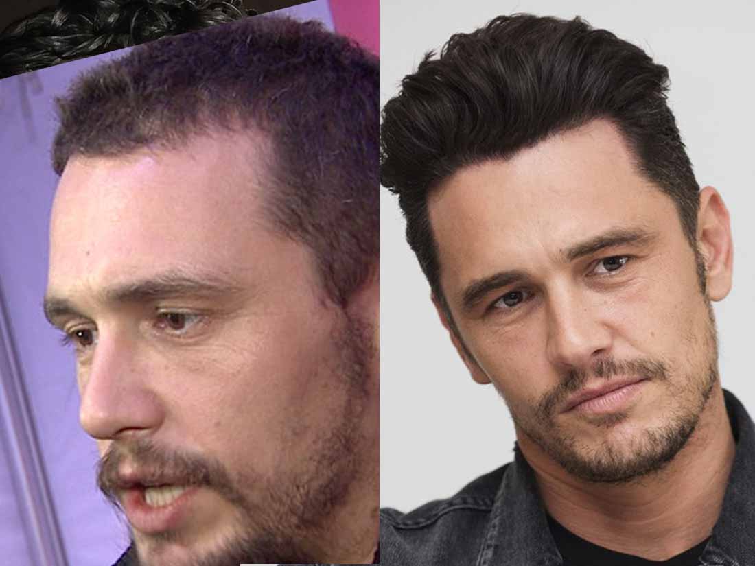 james-franco-hair-transplant-before-and-after