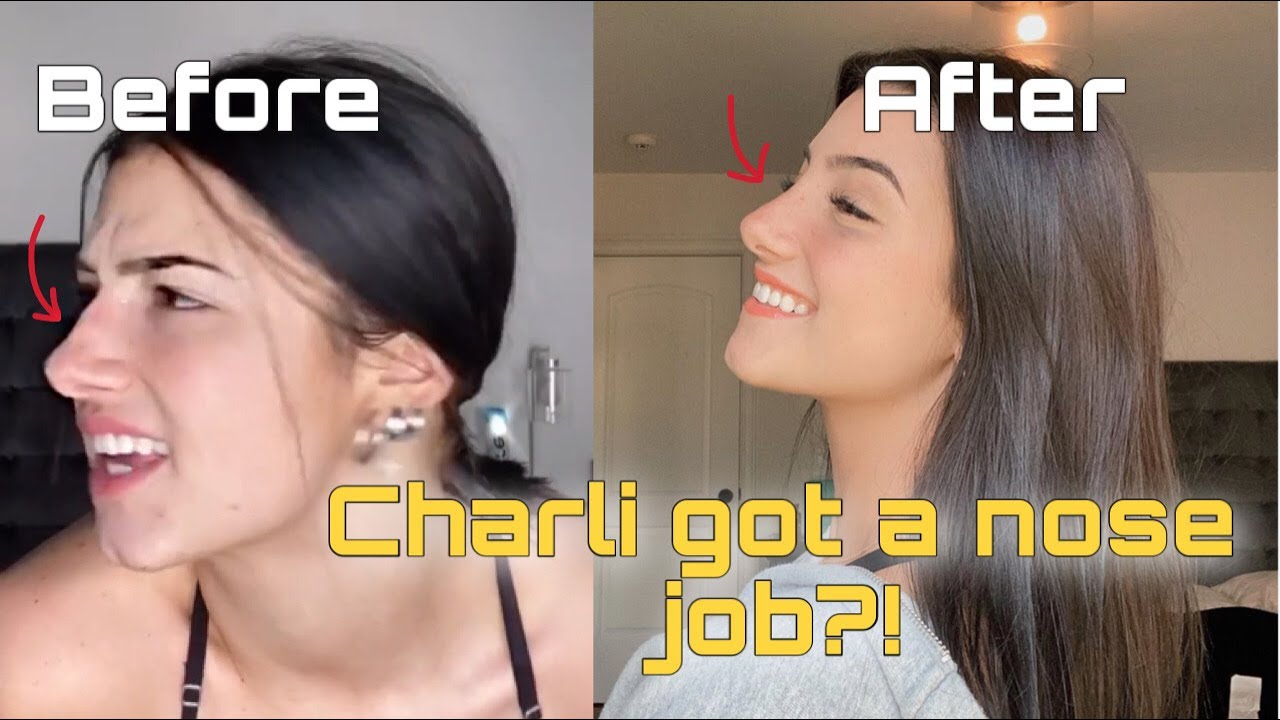 charli-damelio-nose-job before after