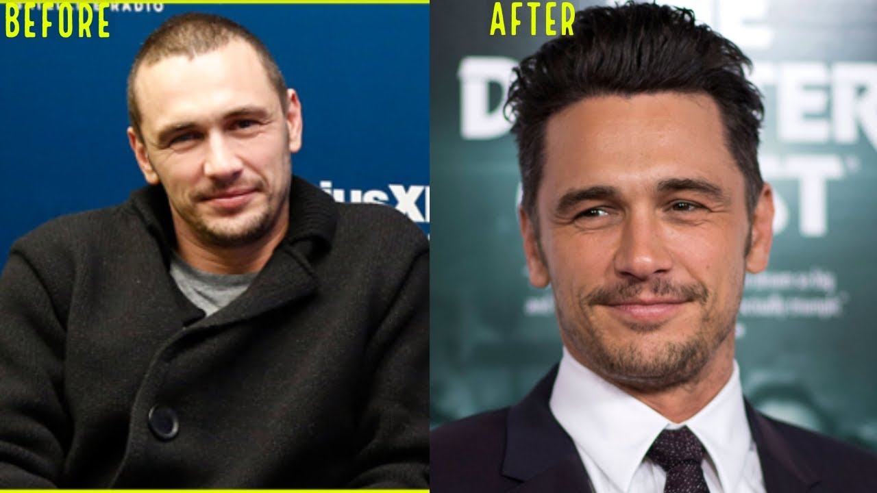 james-franco-hair-transplant