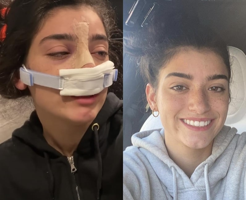 Dixie Damelio Nose job before after