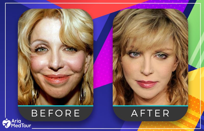 Courtney Love Nose Job