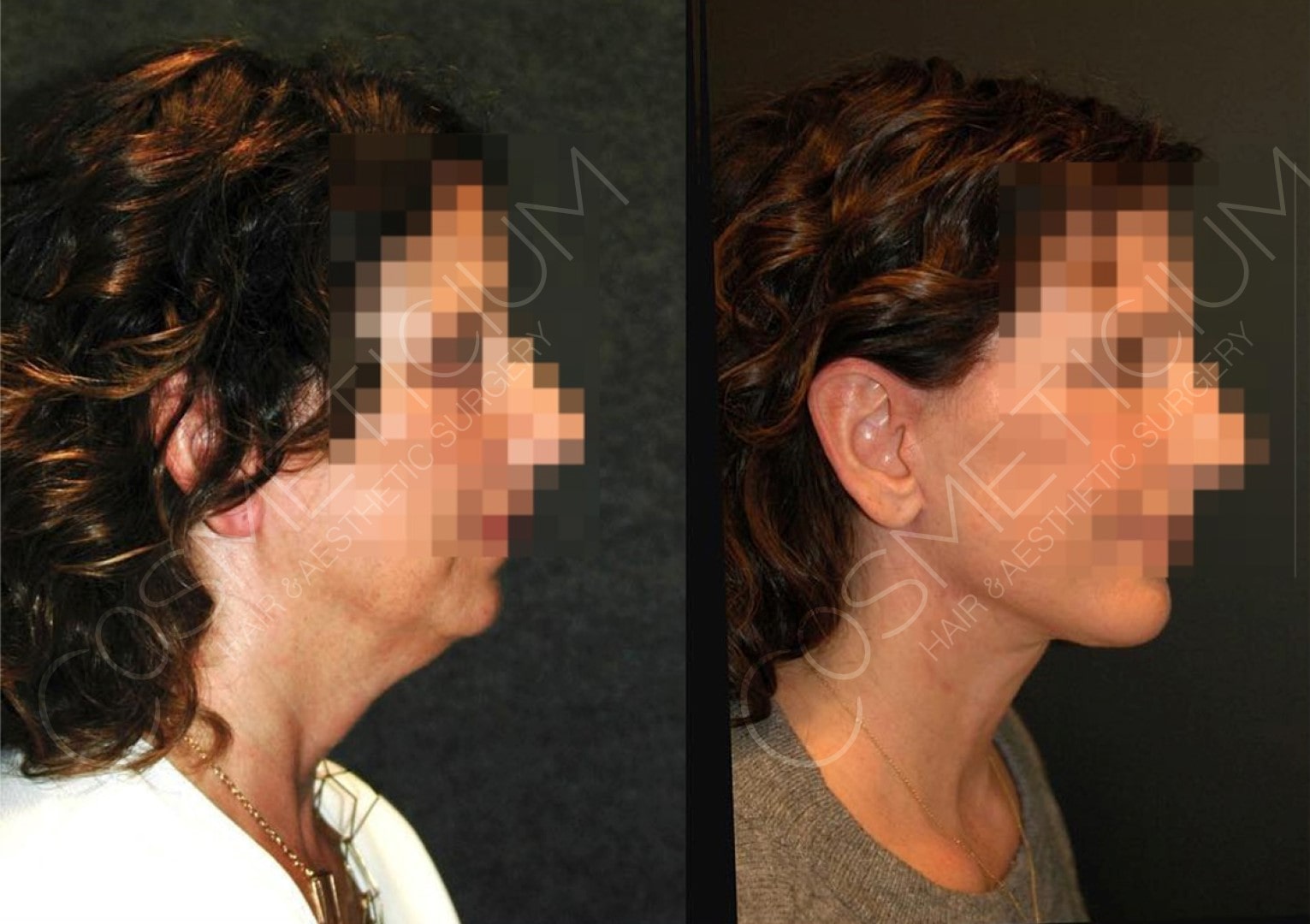 Neck liposuction before after turkey