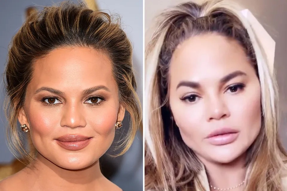 Chrissy Teigen is the only celebrity to publicly announce she has had the procedure
