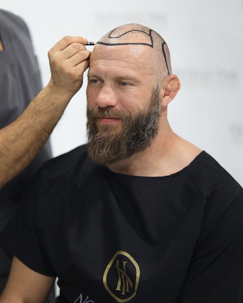 Donald Cerrone Hair before after