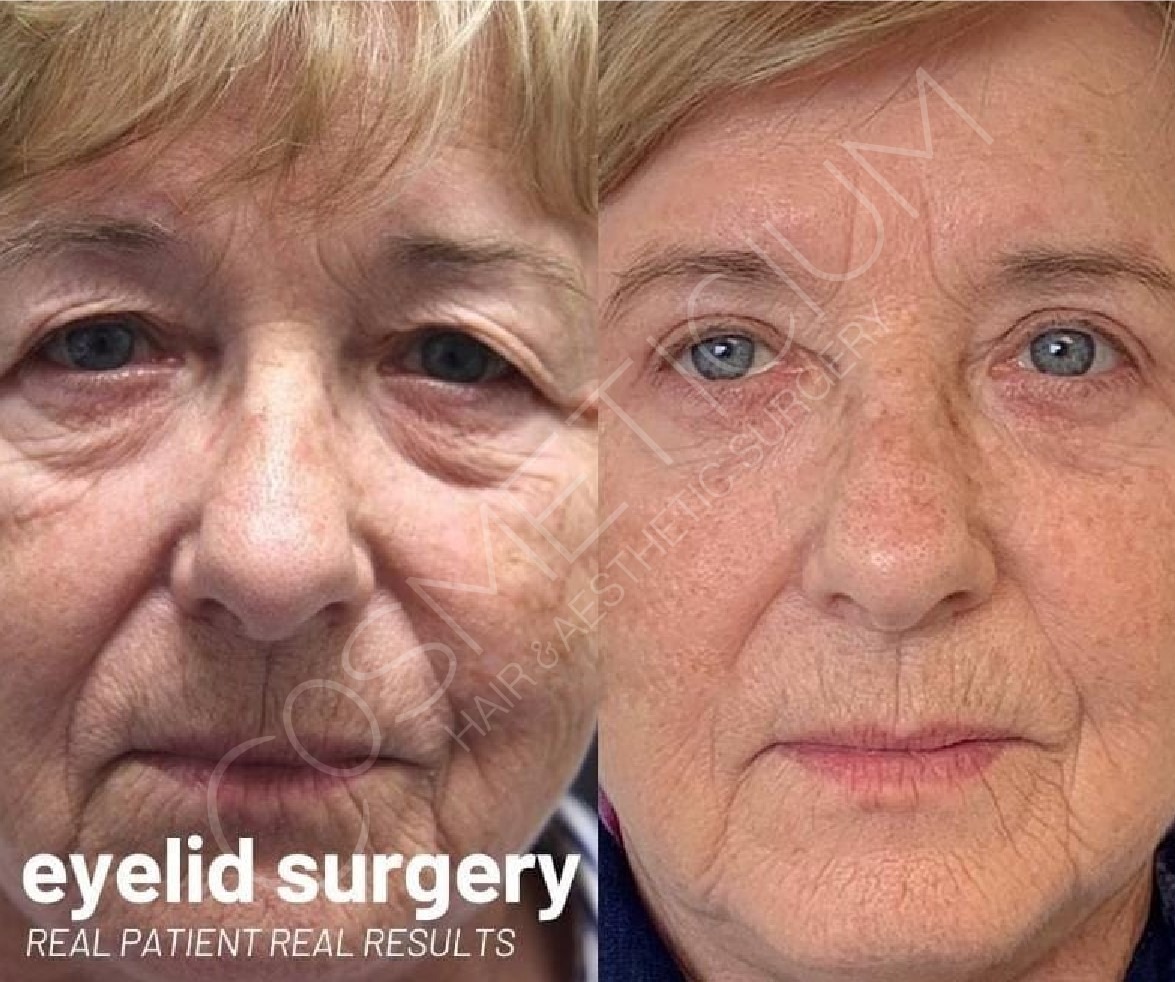 eyelid turkey surgery