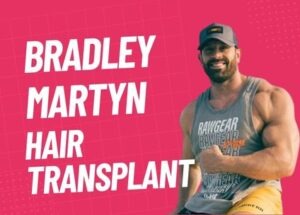 Bradley Martyn Hair Transplant