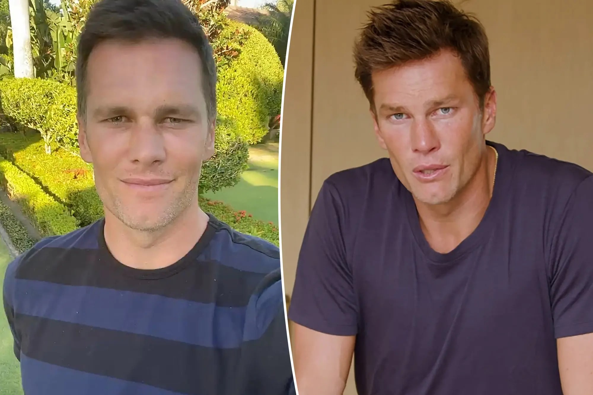 Tom Brady Botox