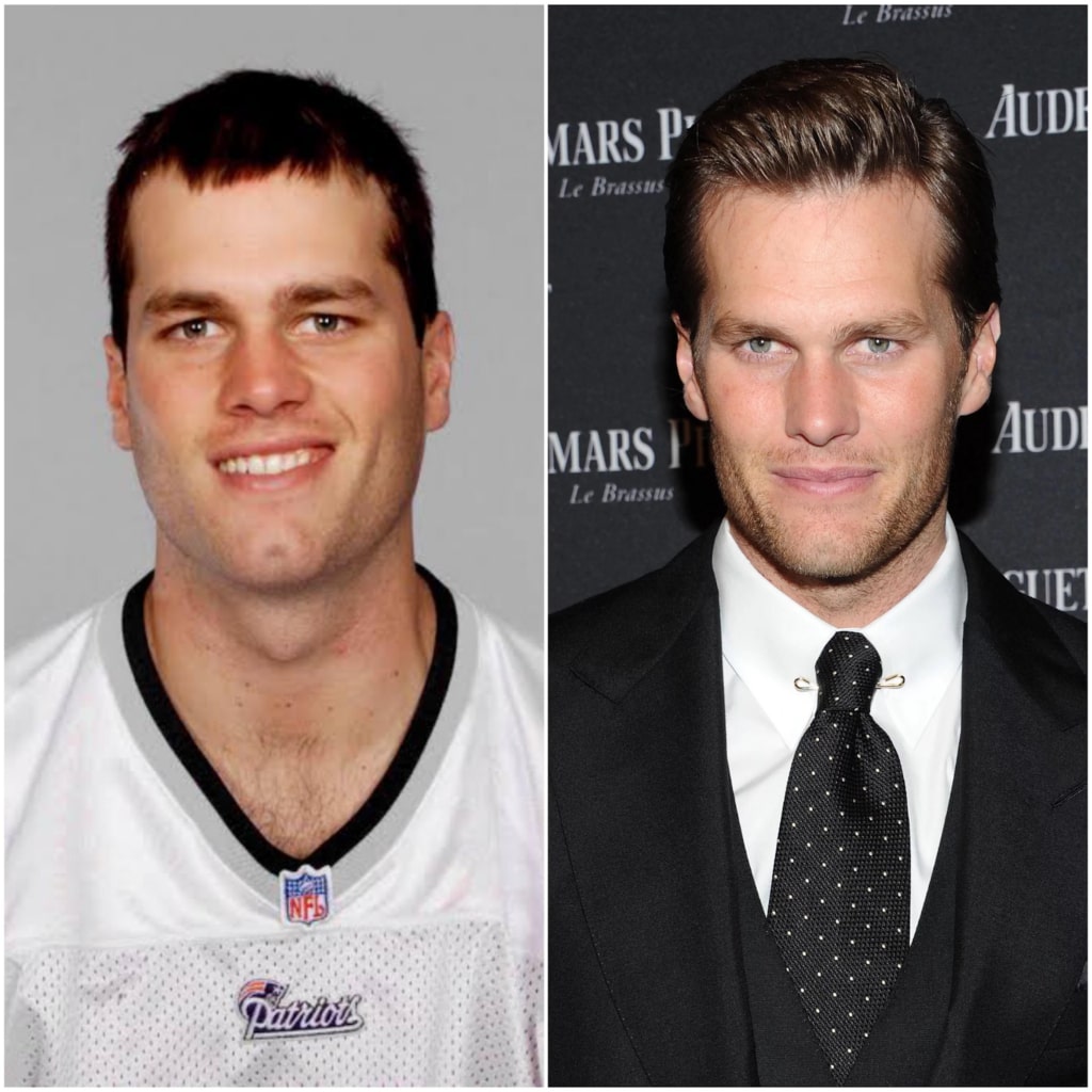 Tom Brady Botox before after